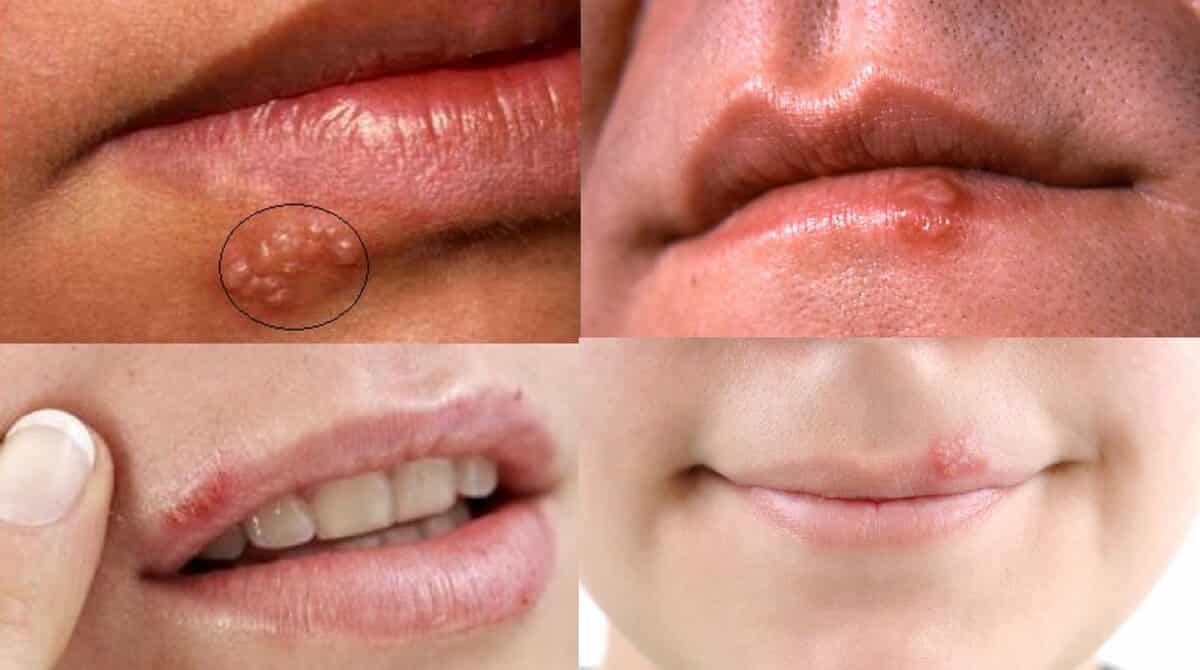 herpes-labial-inicial